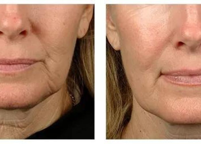 lassita cutanea aureal (2)