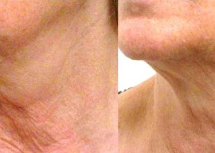 lassita cutanea aureal (5)