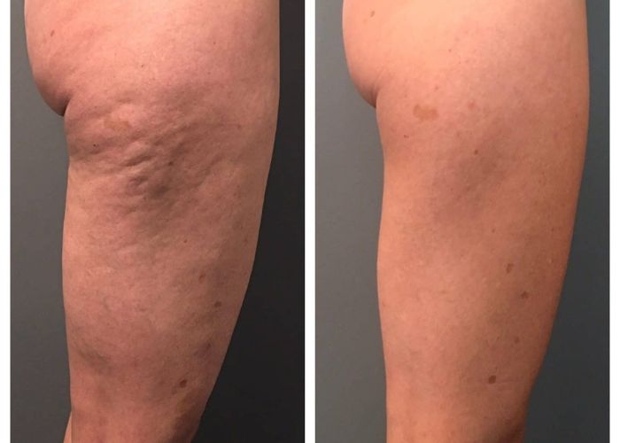 lassita cutanea aureal (6)