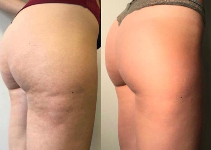 lassita cutanea aureal (8)