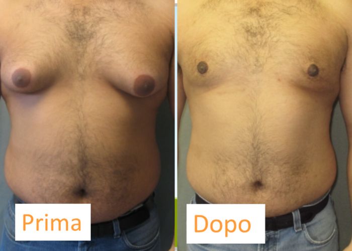 Coolsculpting Petto - Aurial (2)