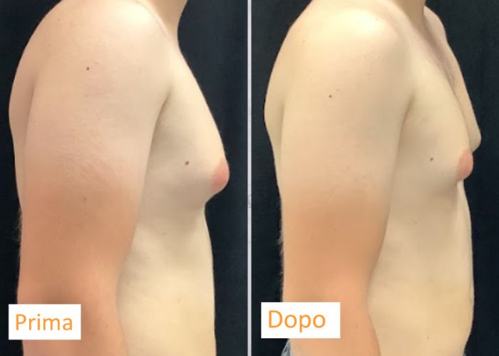 Coolsculpting Petto - Aurial (4)