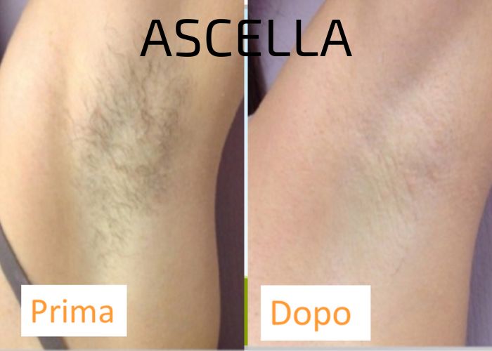 EPILAZIONE LASER ASCELLA - AUREAL