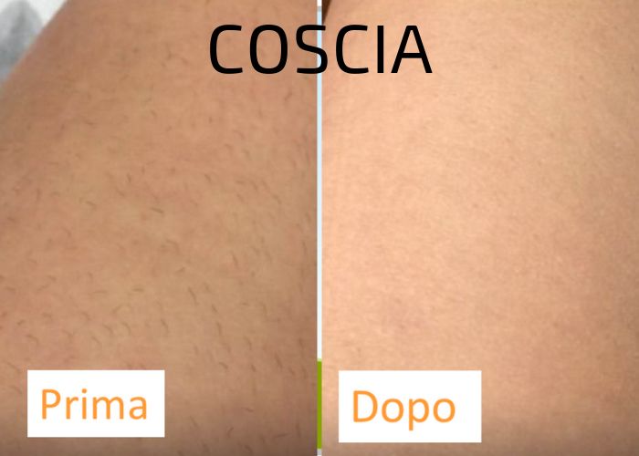 EPILAZIONE LASER COSCIA - AUREAL