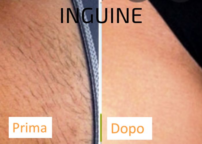 EPILAZIONE LASER INGUINE - AUREAL