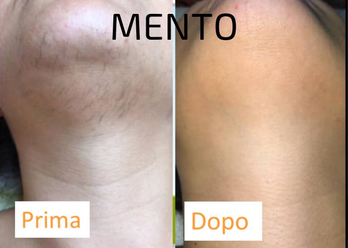 EPILAZIONE LASER MENTO - AUREAL