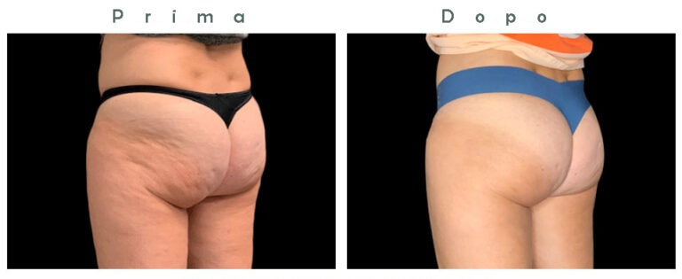 Glutei 1