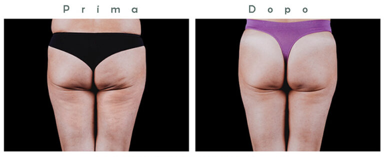 Glutei 2