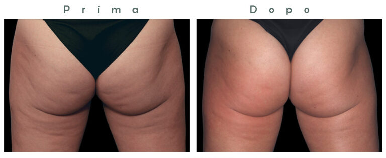 Glutei 3