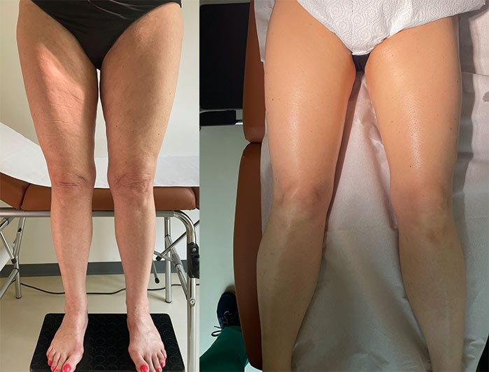 elettroporazione-acido-ialuronico-milano