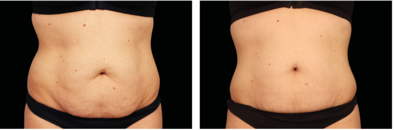 emtone-before-after-stomach-1024x338