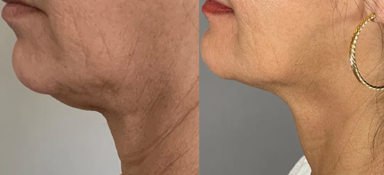 FACEtite-BA-PTAK_InMODE (1)