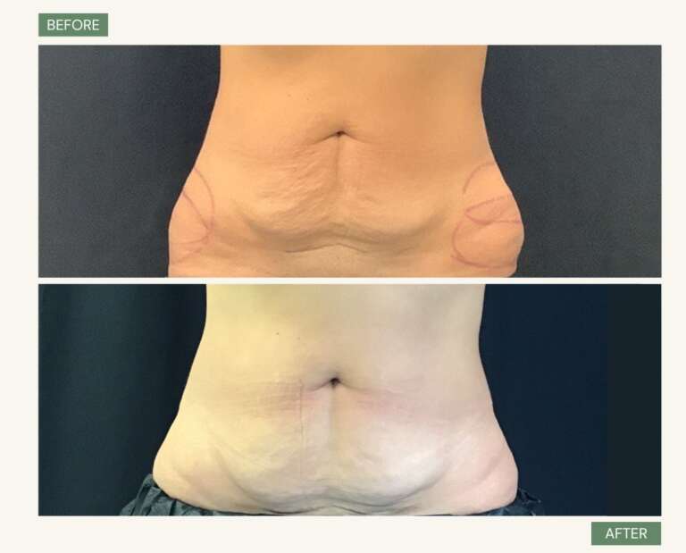 Coolsculpting donna fianchi img