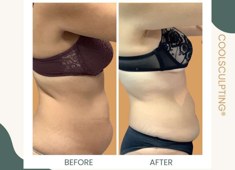 Coolsculpting donna profilo