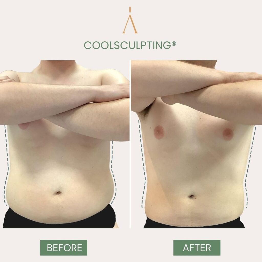 Coolsculpting uomo
