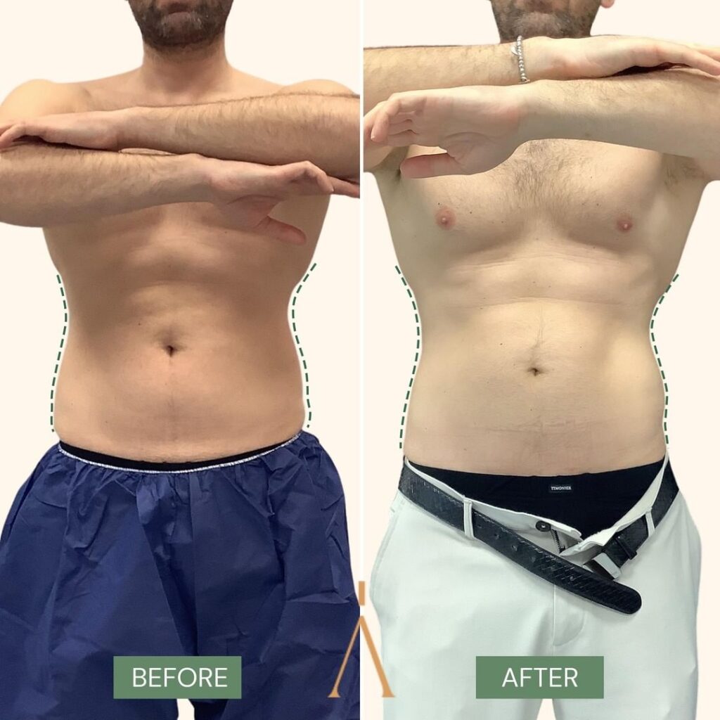 Coolsculpting uomo front
