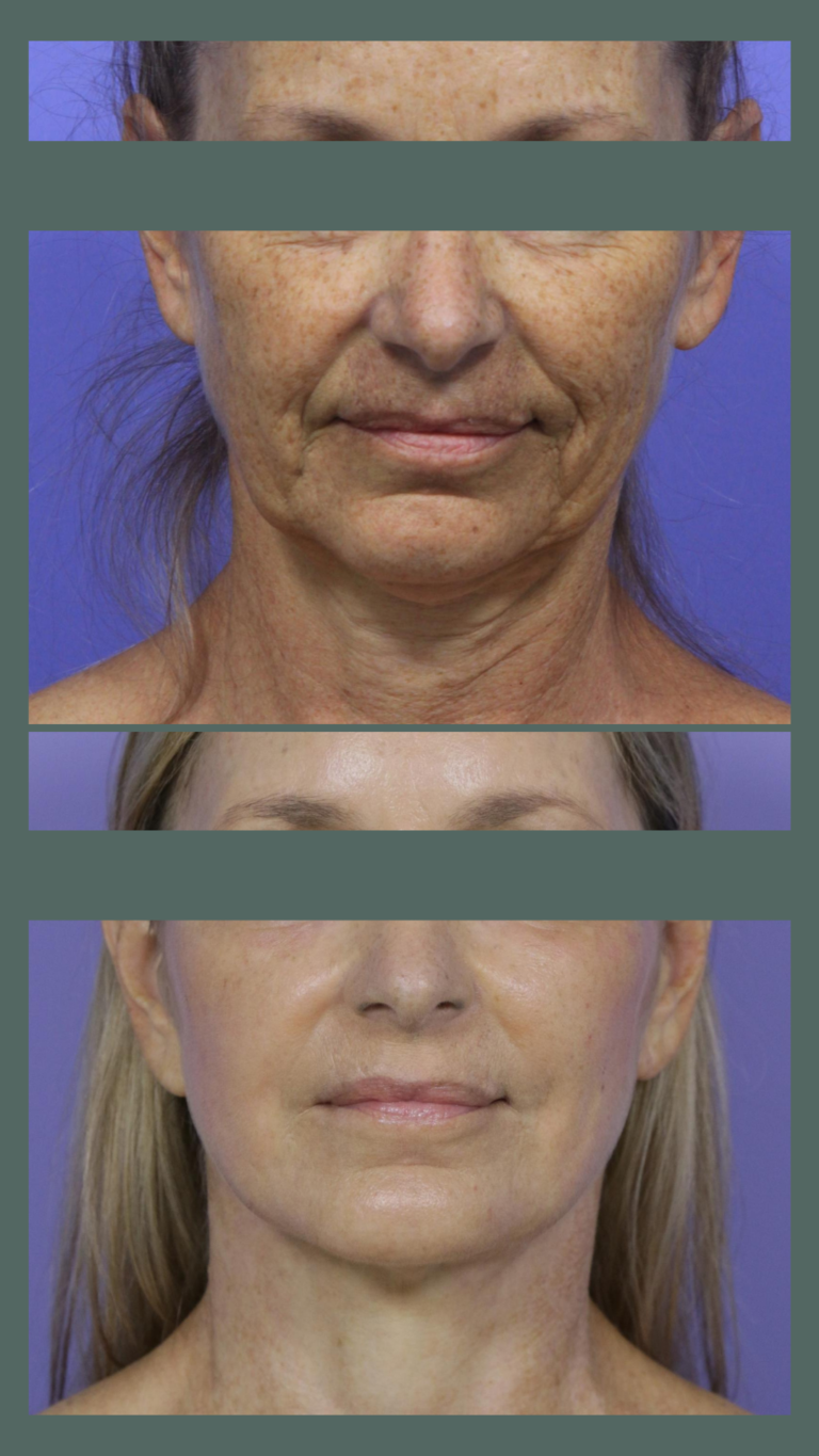 aureal face lift