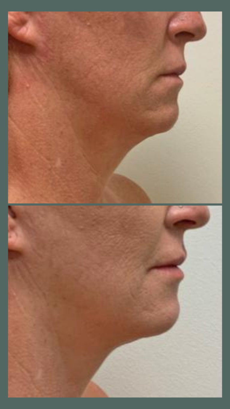 aureal face lift