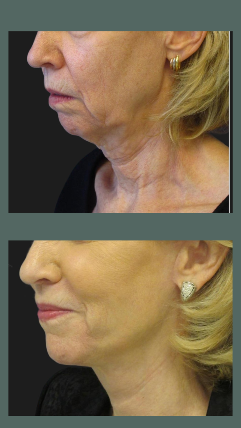 aureal face lift