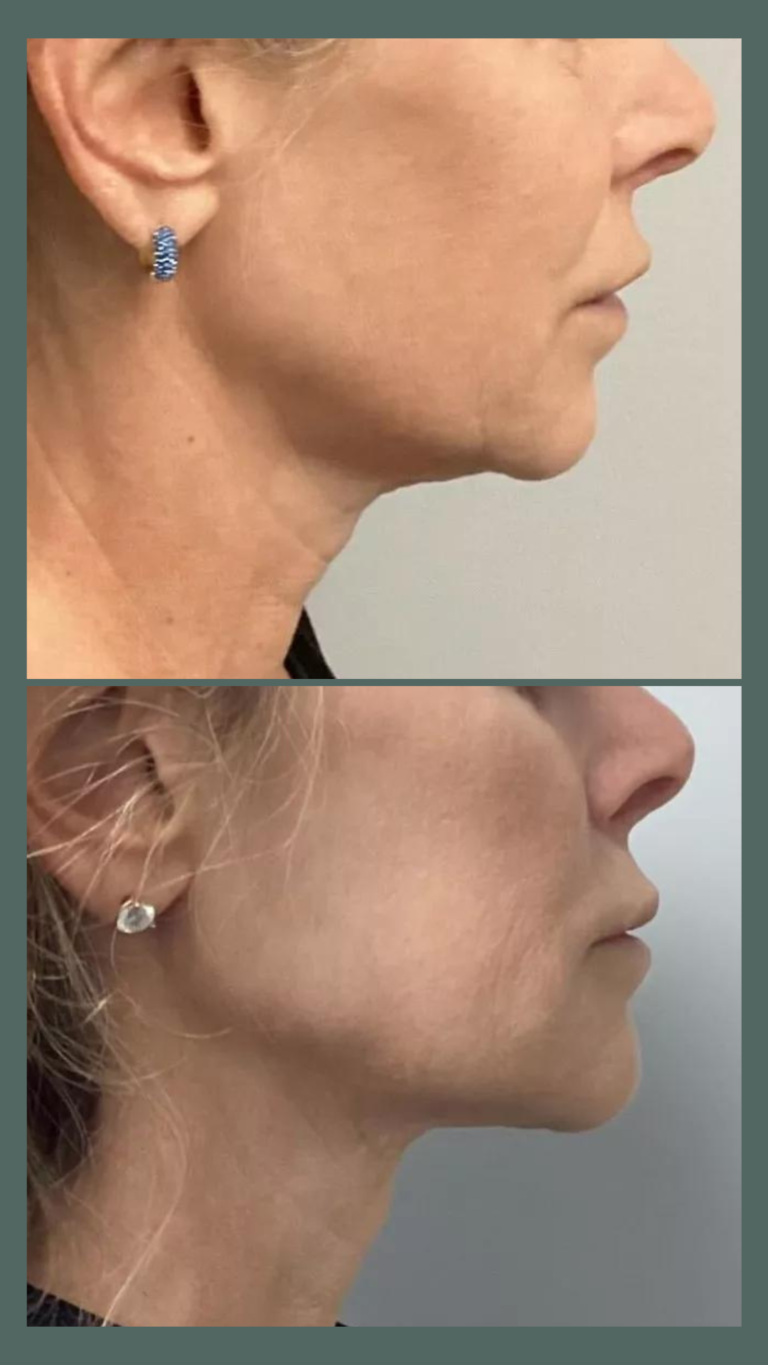 aureal face lift