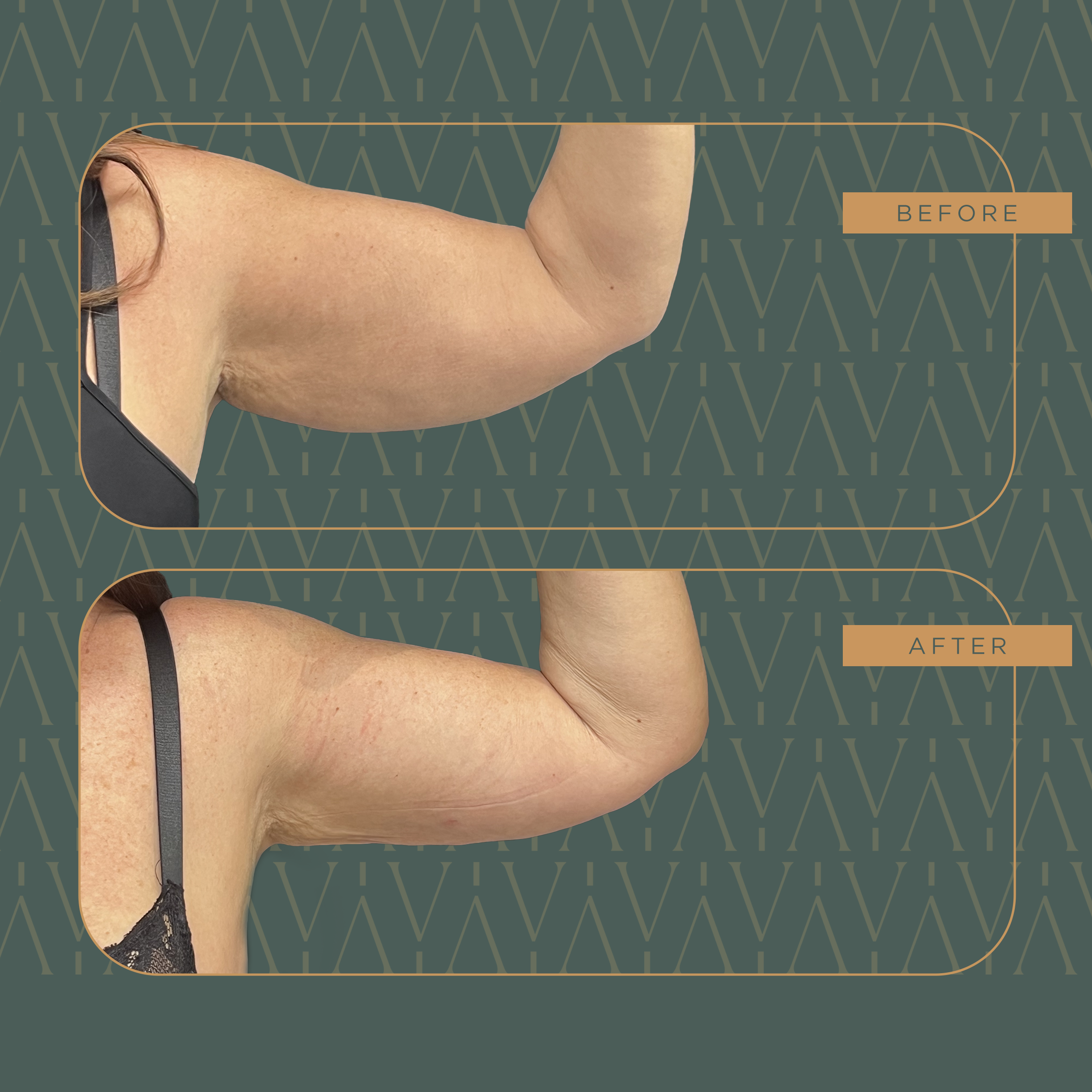 BODYTITE BRACCIA copia (2)